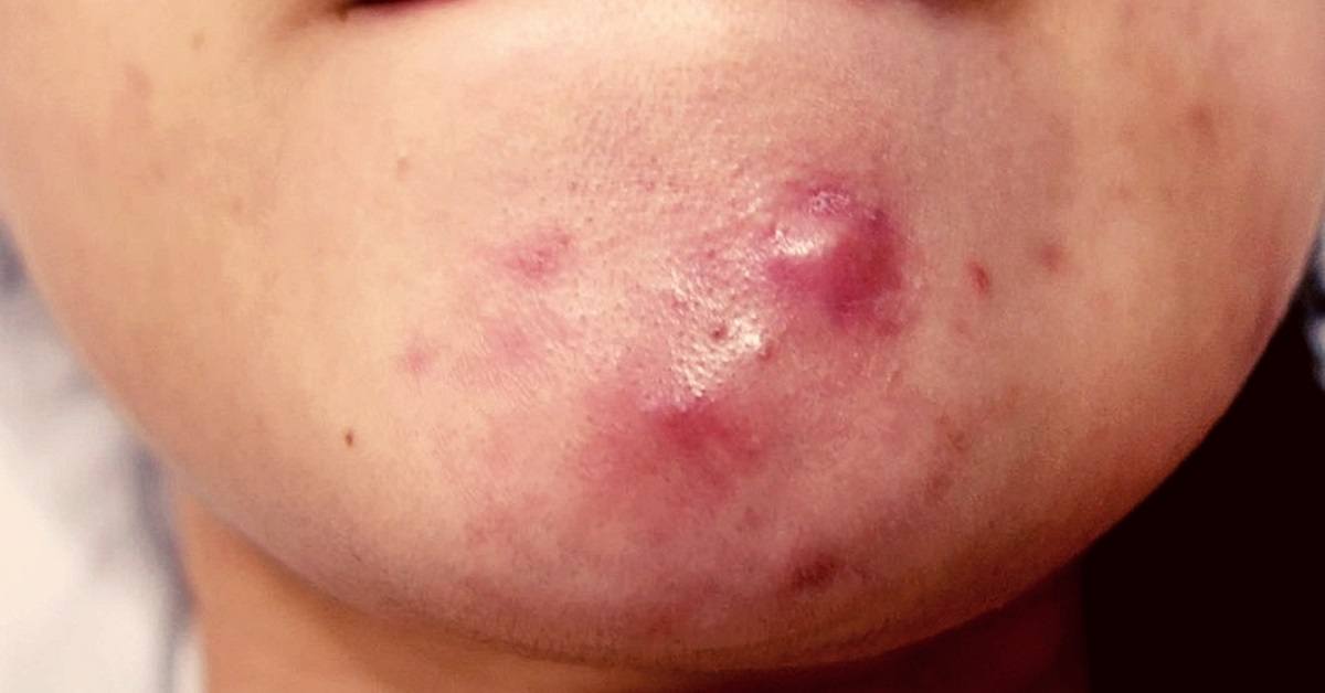 List: Best Essential Oils For Cystic Acne & Methods Of Use Effectively