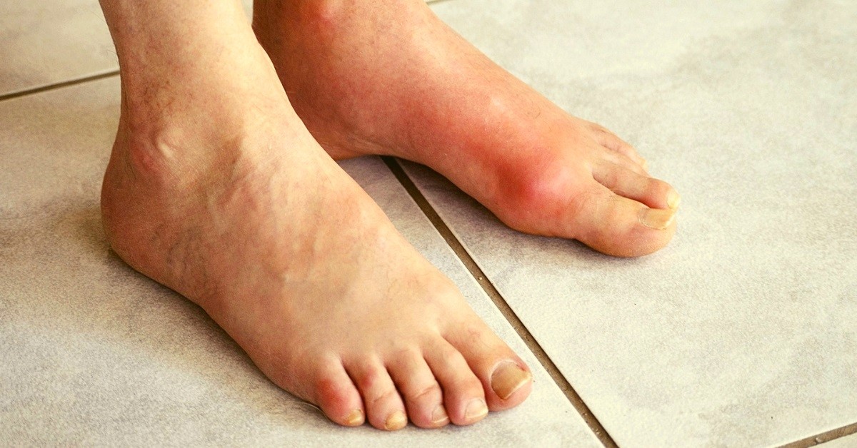 essential oils for gout