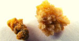 Top Essential Oils For Kidney Stones & How To Use For Pain Relief