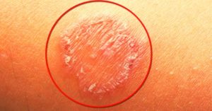 Best Essential Oils & Recipes For Ringworm To Use Effectively